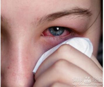 如何正確護理眼睛結膜炎？