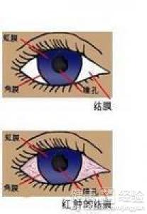 眼睛紅就是得了結膜炎嗎？