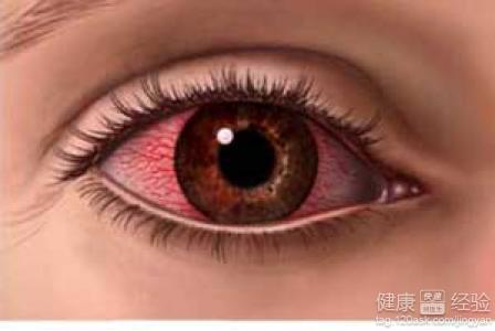 眼結膜炎能傳染嗎？
