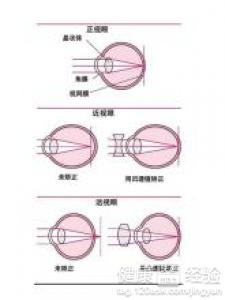 眼部疾病——結膜炎的具體症狀