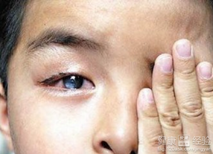 角膜炎用什麼眼藥說可以治愈