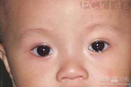 孩子眼睛發紅，是結膜炎的症狀嗎