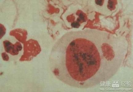 濾泡性結膜炎的發病原因和療法