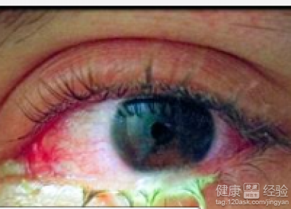 眼結膜炎的引起原因