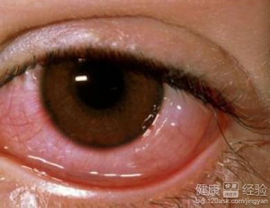 急性結膜炎要避免哪些眼部刺激