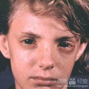 結膜炎的後遺症有哪些