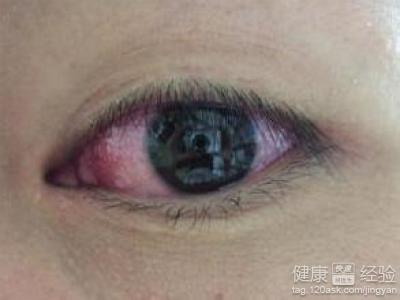 結膜炎會導致視力受損嗎
