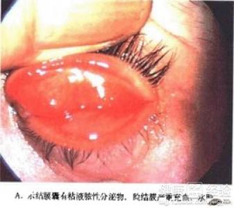 結膜炎預後眼部如何護理