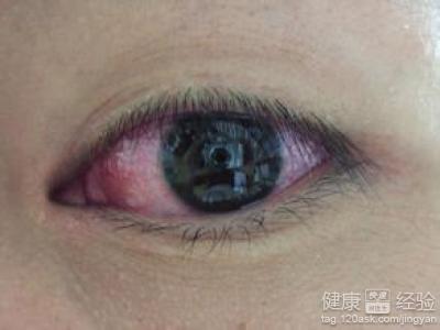 雙眼輪流紅眼的結膜炎是什麼原因