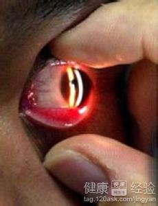 結膜炎眼睛充血是什麼現象呢