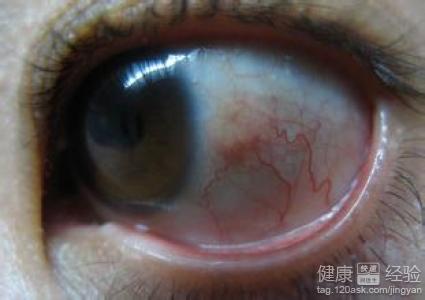 患結膜炎有什麼影響