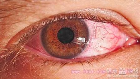 結膜炎導致紅眼睛要怎麼治