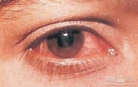 眼睛紅疼痛流淚是結膜炎怎麼辦