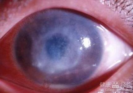 得過過敏性眼結膜炎會在得嗎