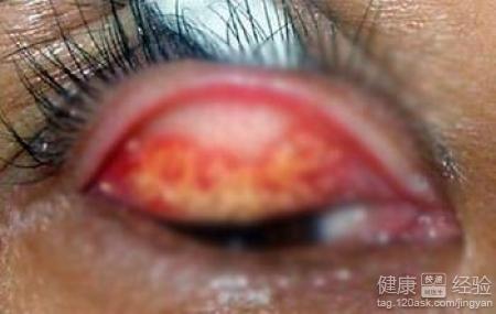 眼角膜炎怎麼治療