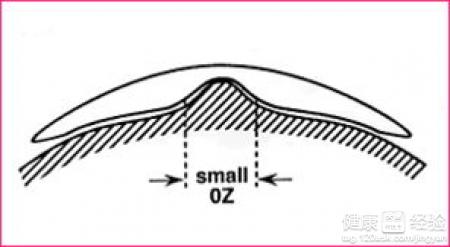 圓錐角膜怎麼辦
