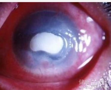 結膜炎用什麼眼藥水好