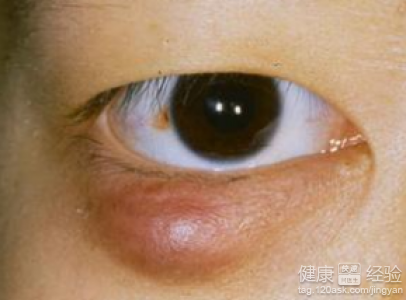 麥粒腫點什麼眼藥水