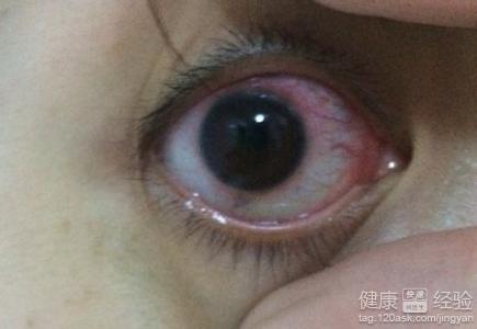眼睛遇風流淚畏光是怎麼回事