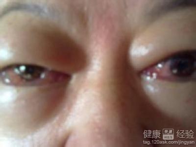 眼角被樹枝刮到後一直流淚該怎麼緩解