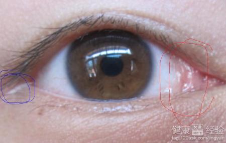 眼睛有干澀血絲怕光流淚吃什麼藥治療