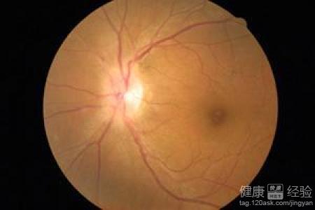 視網膜中央動脈阻塞怎麼辦