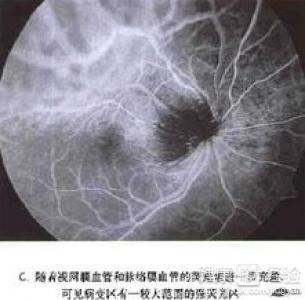 脈絡膜惡性黑色素瘤怎麼辦