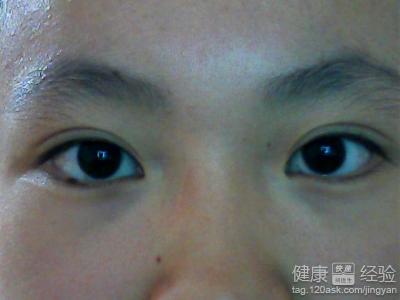 成年人弱視能治好嗎