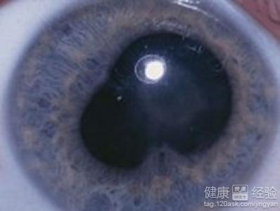 急性前葡萄膜炎怎麼辦