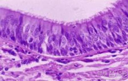 結膜上皮內新生物怎麼辦