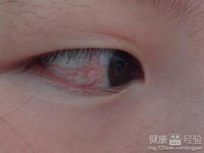 眼睛干澀又有紅血絲,該如何消除呢