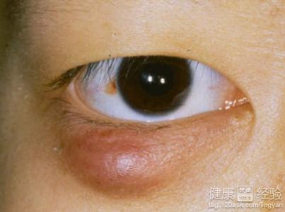 麥粒腫怎麼防治
