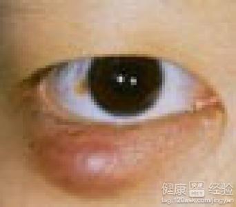 預防麥粒腫要從眼部衛生開始