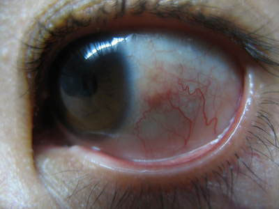 惡性青光眼的發病因素