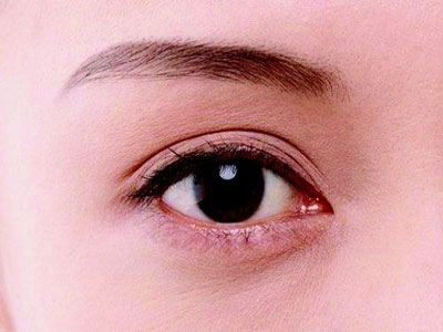 慢性虹膜炎致惡性青光眼