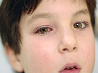 病毒致病是紅眼病的病因