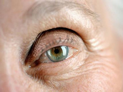 眼皮下垂是怎麼回事？