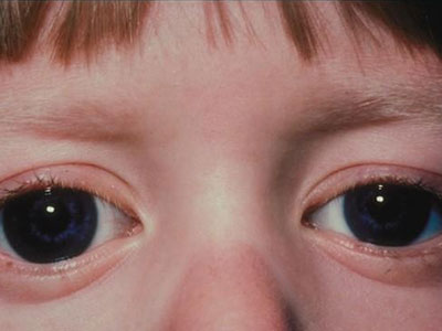 小孩愛揉眼睛是什麼原因？當心先天性青光眼