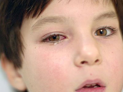 眼睑紅腫是因酒渣鼻？