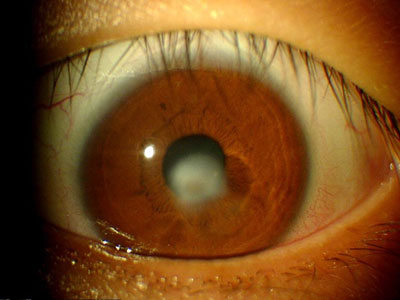 眼睑長黃色腫塊是怎麼回事？
