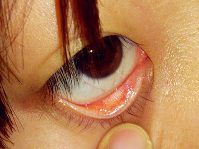 兒童沙眼多由父母傳染