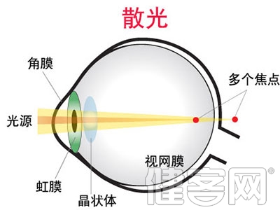 兒童患散光多因媽媽太懶了