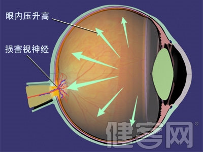 近視度數突然加深 原是青光眼加白內障