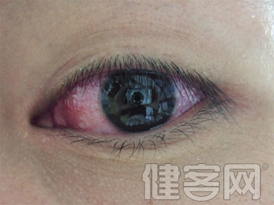 “紅眼病”有可能是因為高血壓