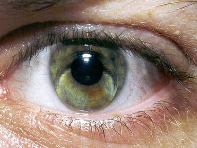 眼睛干澀刺痛？詳解干眼症症狀表現有哪些