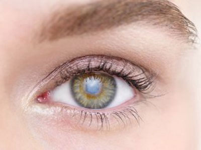 紅眼病初期症狀會有什麼呢