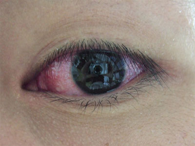 紅眼病初期症狀是什麼