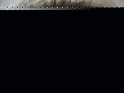 糖尿病眼底出血的症狀有什麼