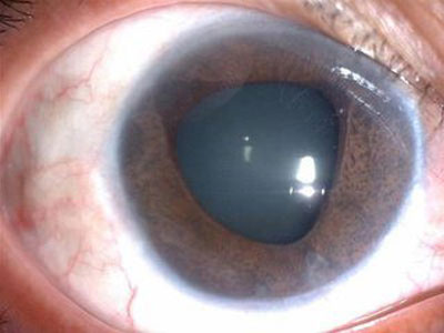 眼球突出容易與哪些症狀混淆？
