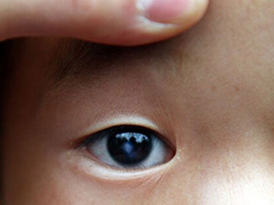 孩子眼睛發白 快去眼科檢查